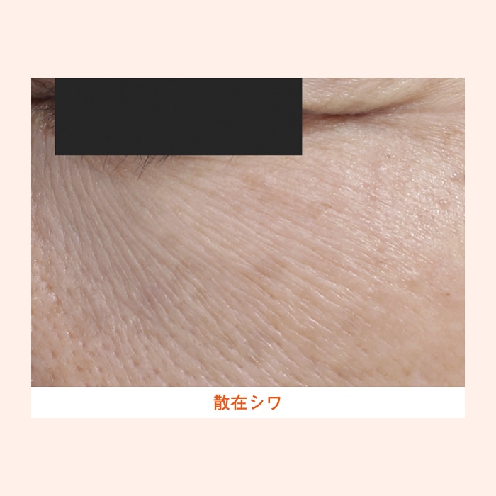 散在シワ画像